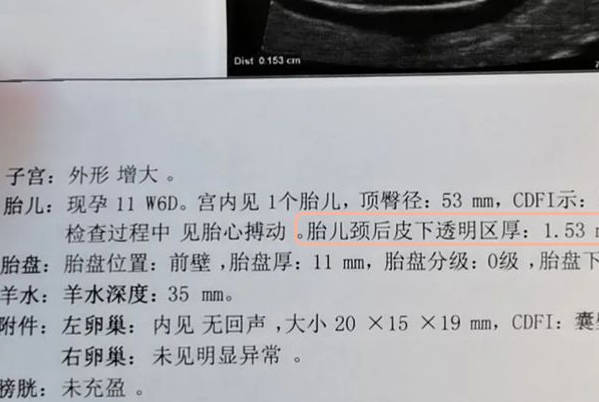 NT值小于1.5mm时生男孩概率更大