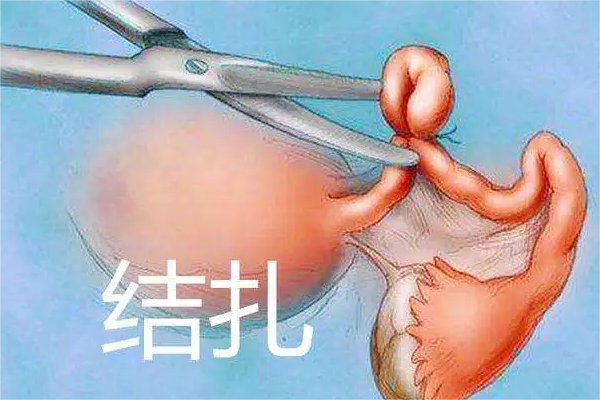 结扎有风险