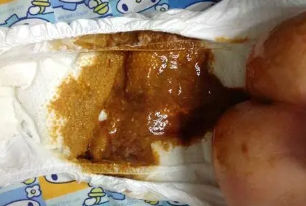 婴儿拉棕褐色大便正常