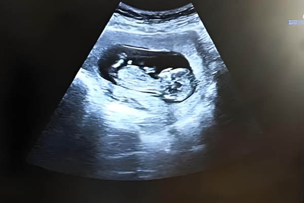 nt值1.5mm是怀男宝几率大还是怀女孩几率大？