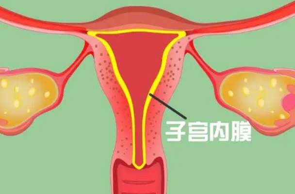 多发内膜息肉没手术影响着床率