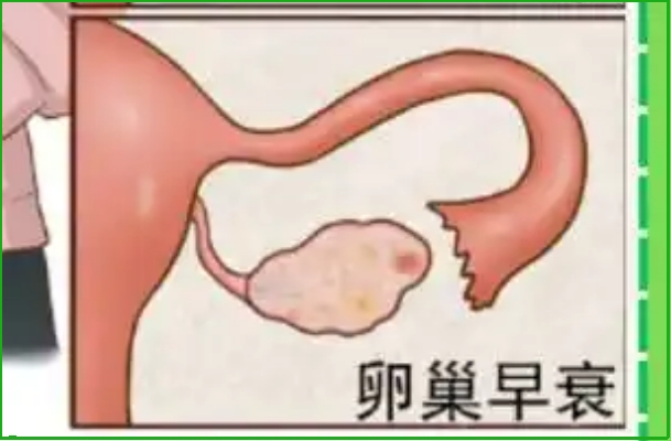 女性备孕期间遇上卵巢早衰该怎么办？