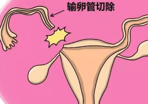 b超显示输卵管有积液存在需要切除后才能进行三代试管吗?