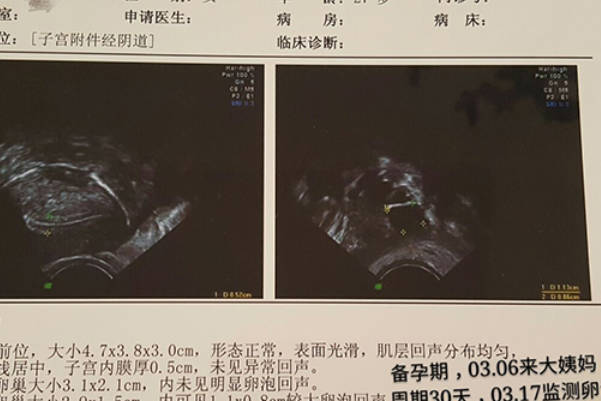 促排卵期间B超检查可了解卵泡发育