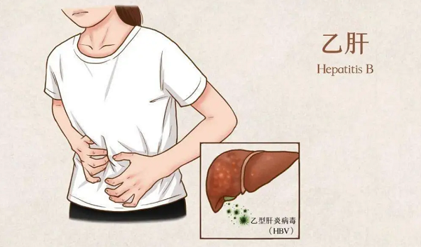 乙肝属于一种慢性感染性疾病