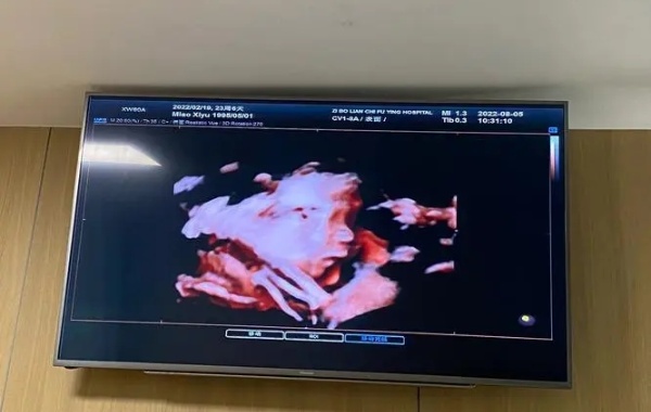 网传双顶径股骨长判断男女的公式很准可信吗？