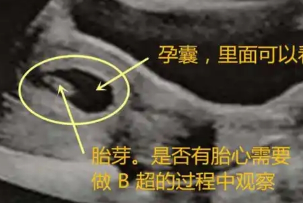 40天孕囊大小几x几，个体差异性尺寸不一样
