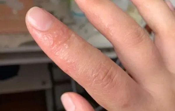 慢性湿疹一般很难自我消退