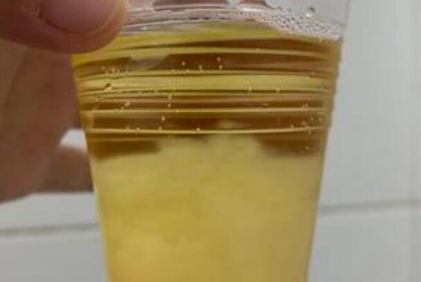 尿液加酒出现分层预示怀儿子
