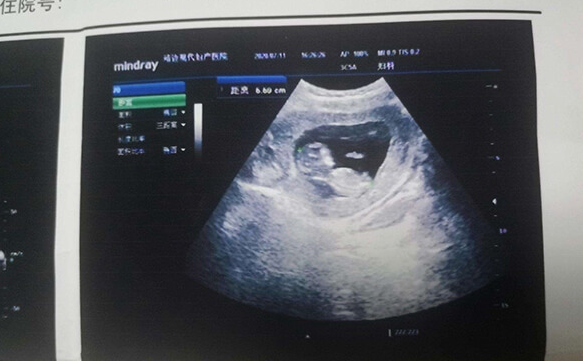 孕12周nt检查数据怎么看怀的是男孩还是女孩？