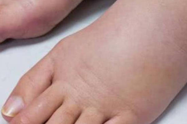 孕晚期脚肿看男女并不准确