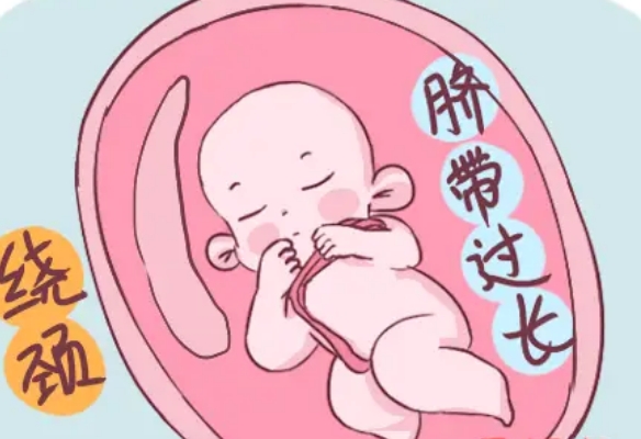 脐带过长导致脐带绕颈