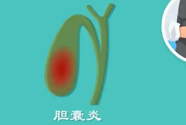 胆囊炎人千万不能吃七大食物，肥肉、油炸食品不可食用