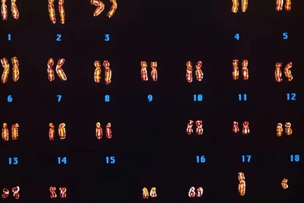 孩子的某一种染色体缺失在国外医疗体系中可以治好吗?