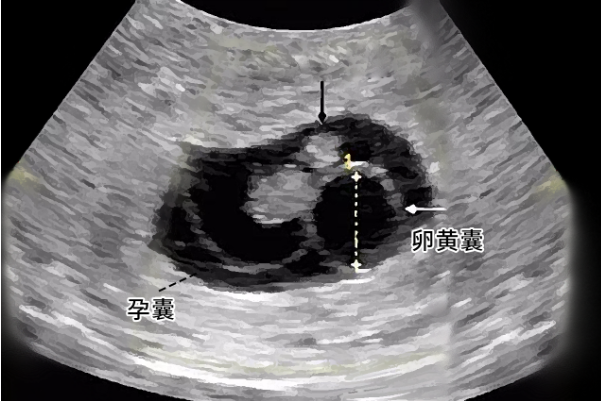 孕囊和血块在b超下可分辨