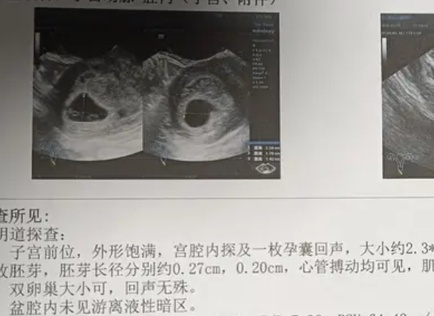 有没有一个孕囊两个胎芽双胞胎的b超图？