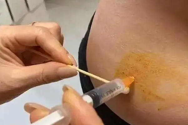 肚脐周围一般是注射美诺孕的位置