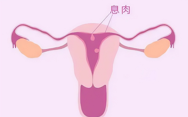 子宫内膜息肉谁做了手术谁后悔的原因是什么?