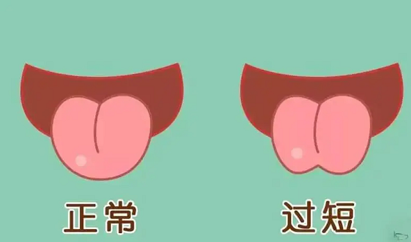 舌系带手术可以解决发音问题