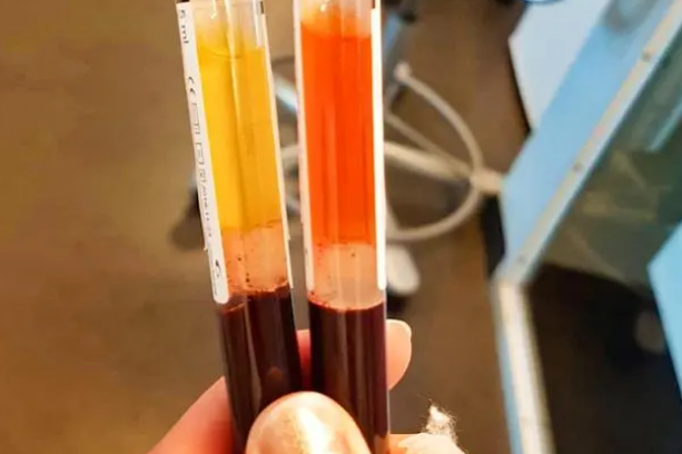 移植后的血液检测是的监测手段