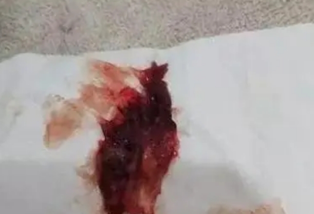 着床后内膜脱落物通常呈现为小的血块