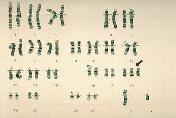 无创检查结果显示18三体数据比较高怀的一般是男娃还是女孩呢?