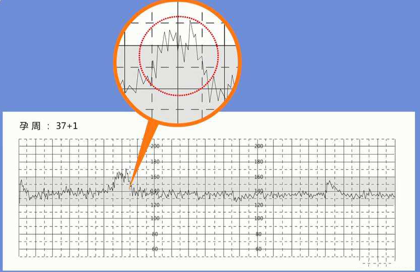 孕晚期胎心率170次/分孕妇怀的男孩还是女孩？
