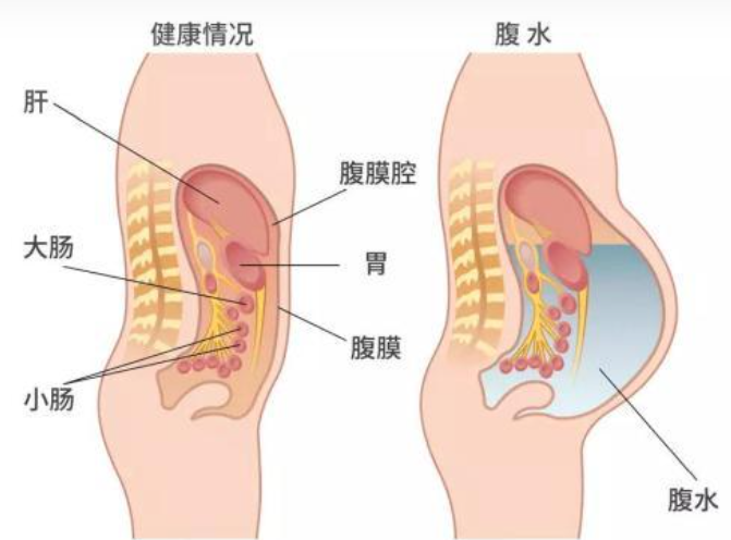 试管取卵后腹水症状了解一下，这几个危害可能伴随一生