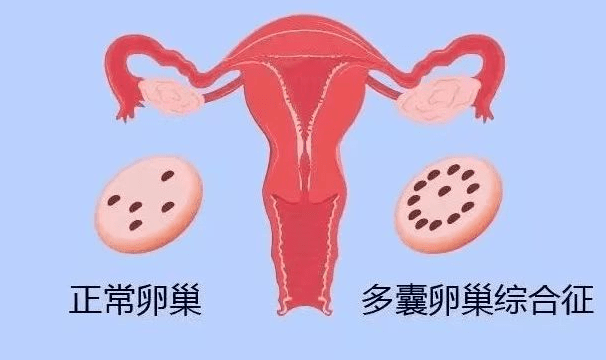 多囊卵巢的发病率在上升