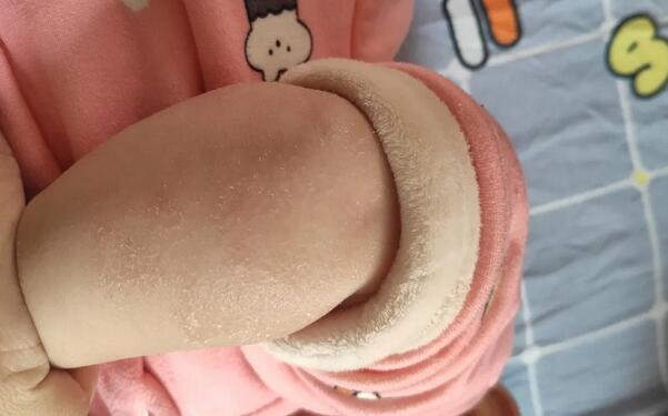 尿布疹俗称红屁股