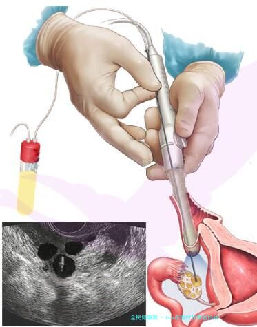 hiv在国内甘肃省妇幼         可以做试管婴儿吗？需要什么条件和要求