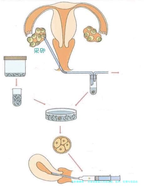天津试管婴儿性别选择：技术、伦理与现实的博弈