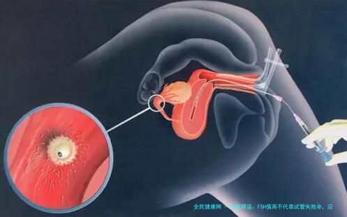 专家辟谣：FSH值高不代表试管失败命，应科学对待（附解决方案）