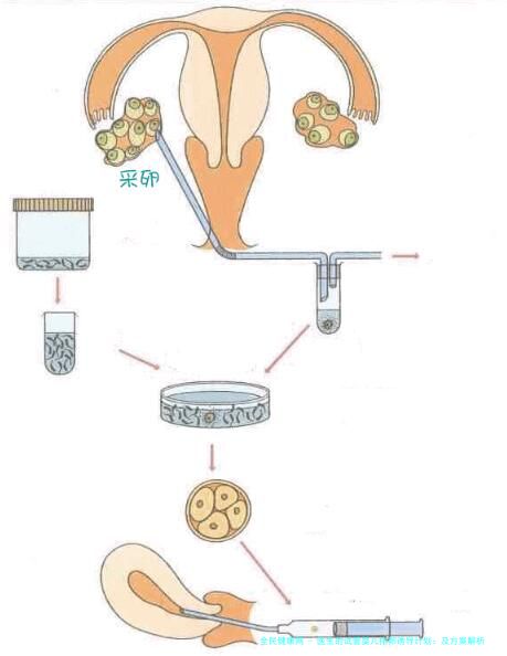 医生的试管婴儿排卵诱导计划：及方案解析
