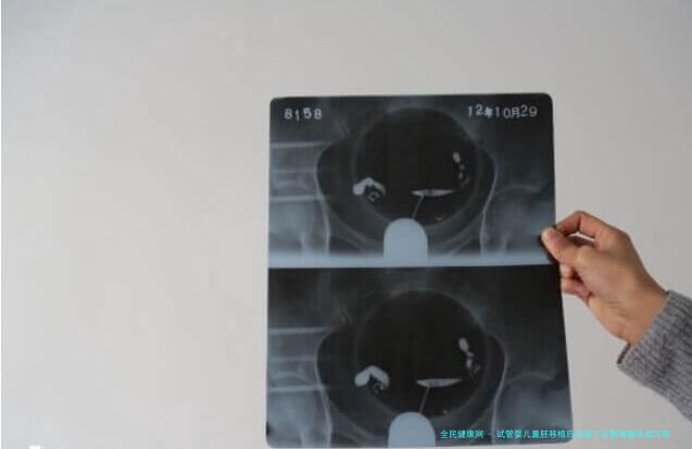 试管婴儿囊胚移植后洗澡了会影响着床成功率吗？