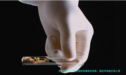 男性婚检疼痛焦虑调查：是医学难题还是心理障碍？