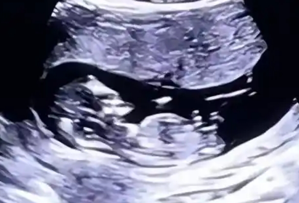 怎么含蓄地向做B超的医生问胎儿是男是女呢？
