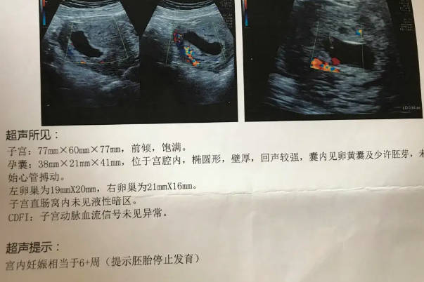 Turner综合征是染色体遗传性疾病