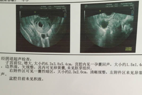 孕囊形态欠规则是精子异常导致