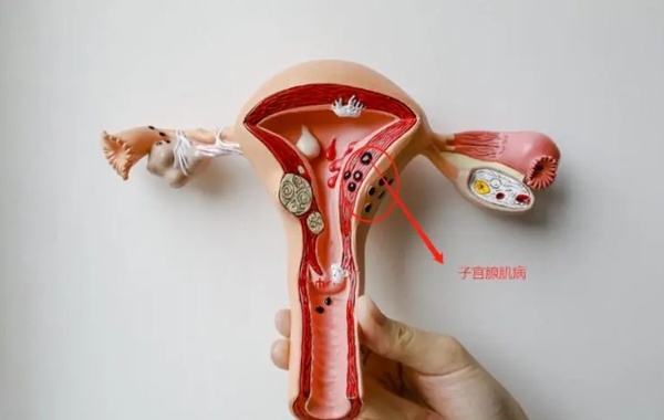 腺肌症自愈几率不是很大