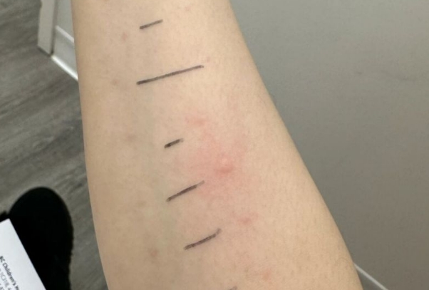 过敏原检测有局限性
