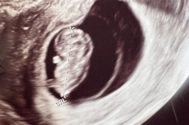 精子类型会决定胎儿的性别