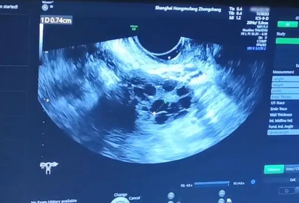 3代试管促排卵期间几天测试一次卵泡发育情况？
