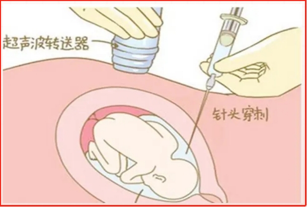 怀孕20周去医院做羊水穿刺前夫妻可以正常同房么？