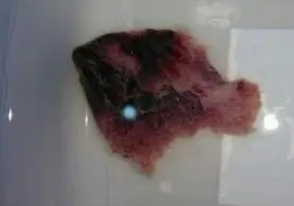 药流出来的孕囊呈囊状结构
