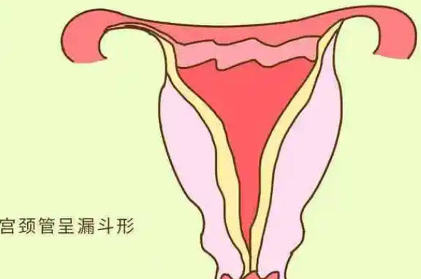 宫颈过短就很容易发生流产