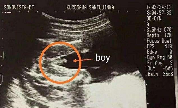 b超是女孩有生下来是男孩的
