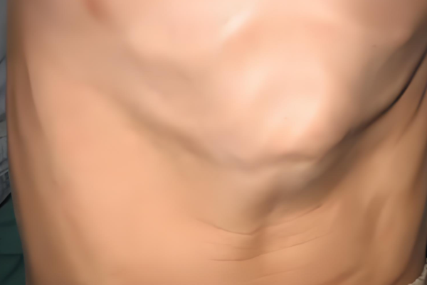 重度鸡胸会压迫儿童心脏