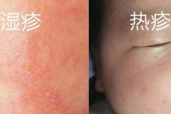 浅析婴儿湿疹和热疹的区别，病因、年龄皆有差异