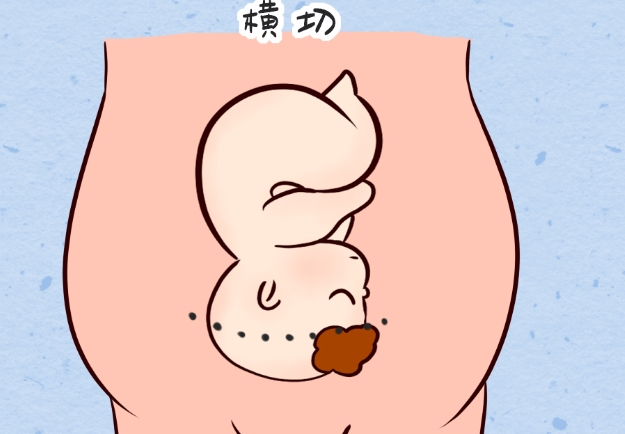 各宝妈破腹产第四胎亲身经历分享，看完才知道风险有多大